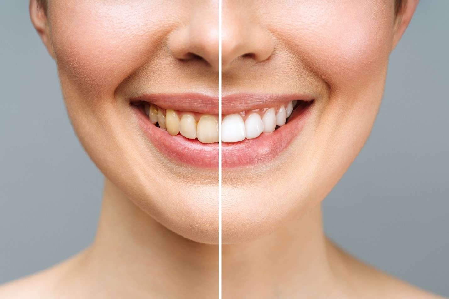 Bandes Blanchissantes FlashSmile