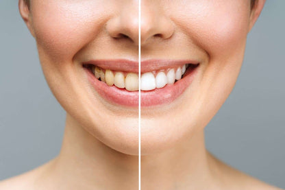 Bandes Blanchissantes FlashSmile