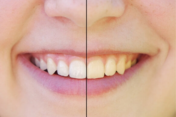 Bandes Blanchissantes FlashSmile
